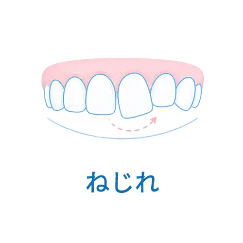 ねじれ